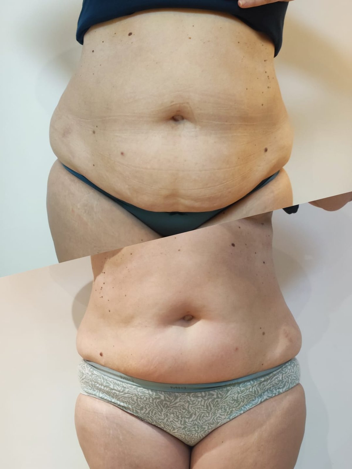 Lymphomodelage méthode